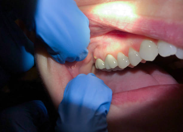 Best Emergency Dental Care for Broken or Chipped Teeth in Sloatsburg, NY